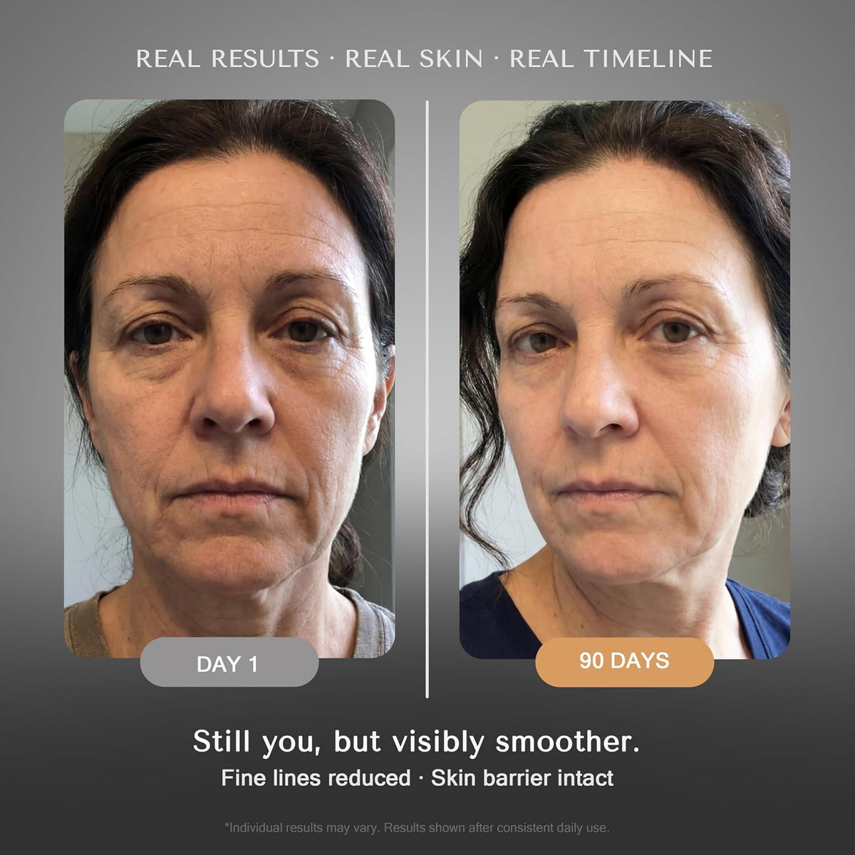 Retinol Serum for Face Wrinkles – Skin Renewing Day & Night System (2 X 30 Ml) – anti Aging Skin Booster Serum, Moisture-Locking Duo for Eyes, Neck & Deep Lines 3-Pack